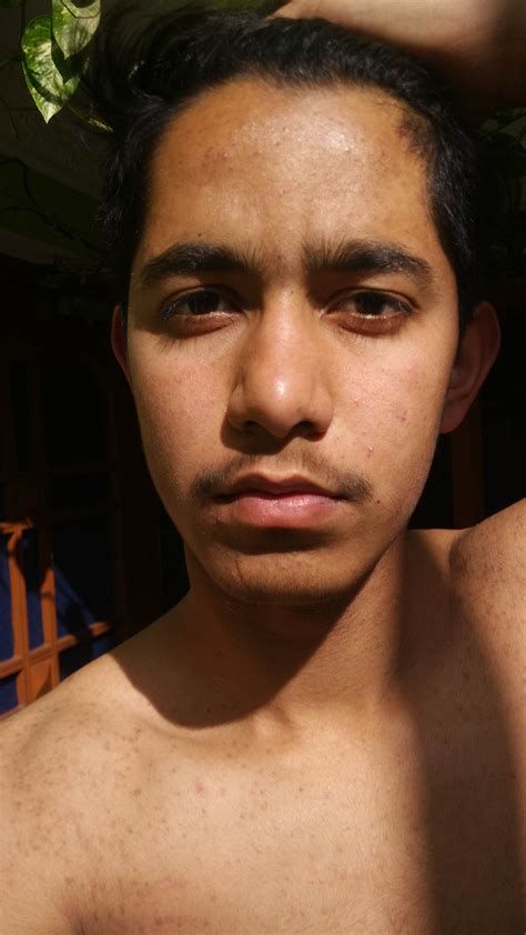 BODY ACNE – General acne discussion – Acne.org Forum