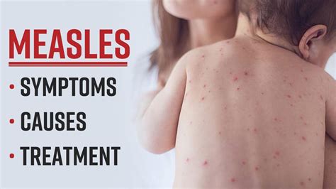 Measles Outbreak In Mumbai ! What Is It, Symptoms, Causes And Treatment, All You Need To Know ...