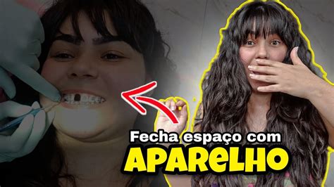 O Meu Dente Saiu Durante A Manuten O Do Aparelho Fixo O Que Eu Fiz