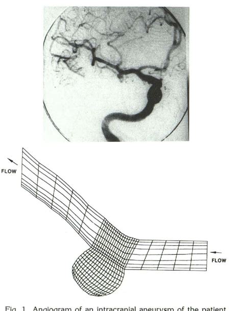 Figure 1 From Origin And Progression Intracranial Aneurysms Flow