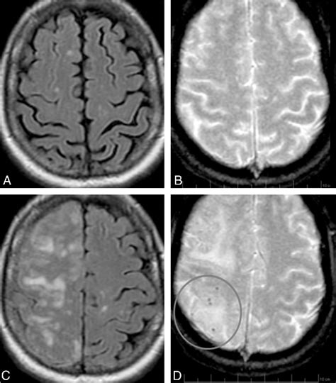 Figure From Mr Imaging Features Of Amyloid Related Imaging