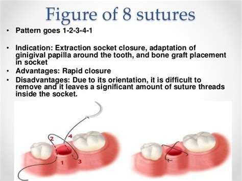 Best Mattresses of 2020 | Updated 2020 Reviews‎: Horizontal Mattress Suture In Periodontics