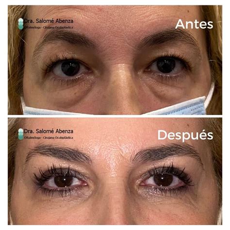 Antes y después Blefaroplastia superior e inferior Salomé Abenza