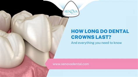 How Long Do Dental Crowns Last Senova Blog