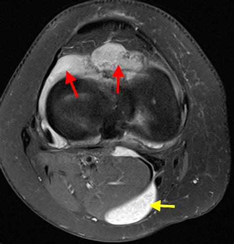 Primary Synovial Chondromatosis - Radsource