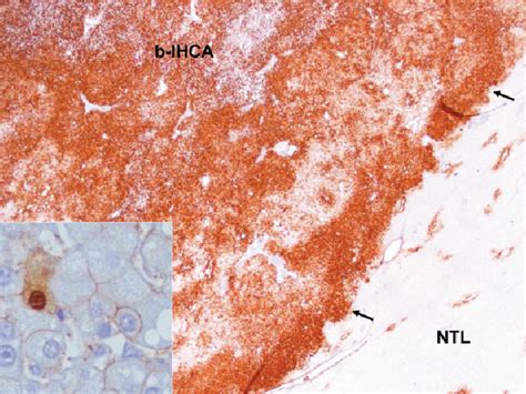 Inflammatory And B Catenin Activated Hepatocellular Adenoma B Ihca