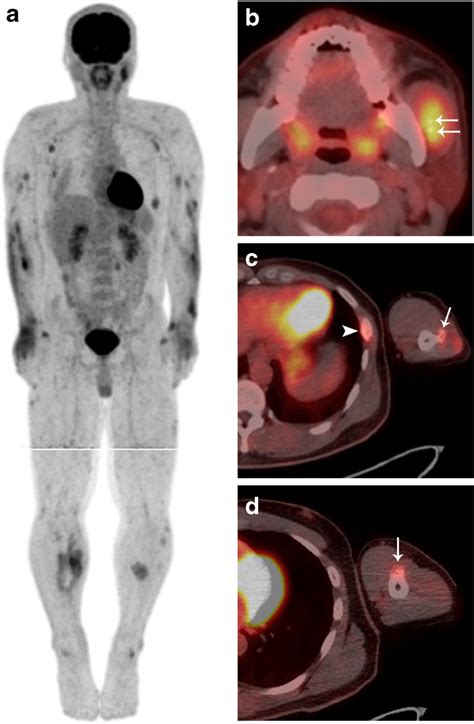 F Fluorodeoxyglucose Fdg Positron Emission Tomography Computed