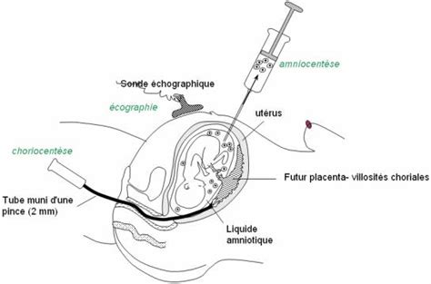 Le Diagnostic Prénatal Superprof