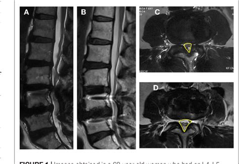 Figure 1 From Oblique Lumbar Interbody Fusion Using A Stand Alone Construct For The Treatment Of