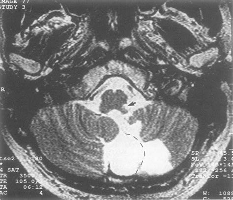 Mri In Axial Section T2 Weighted Image Through The Cerebellum And Download Scientific Diagram