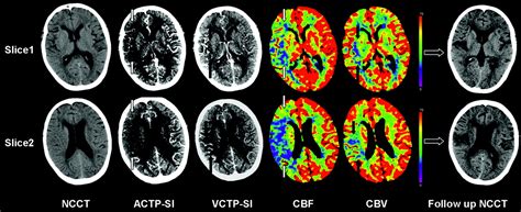 Identification Of Infarct Core And Penumbra In Acute Stroke Using Ct