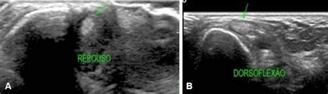 A Ultrasound Of The Left Ankle Displaying Reduced Peroneus Brevis Download Scientific Diagram