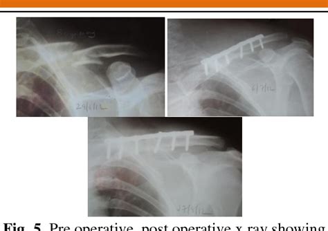 Figure From Analysis Of Displaced Middle Third Clavicular Fractures