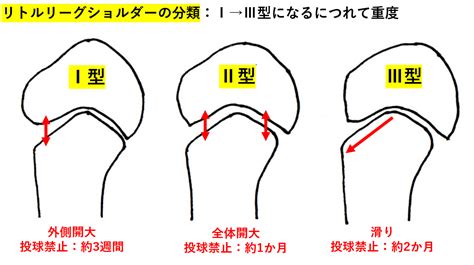 ボールを投げると肩が痛い！なかなか治らない野球肩で困っている選手へ！悪化する前にすぐにでも治療しましょう！ すみだ整骨院 直方飯塚