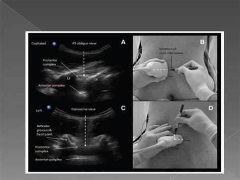 Anestesia Neuroaxial Guiada Por Ecografia Ppt