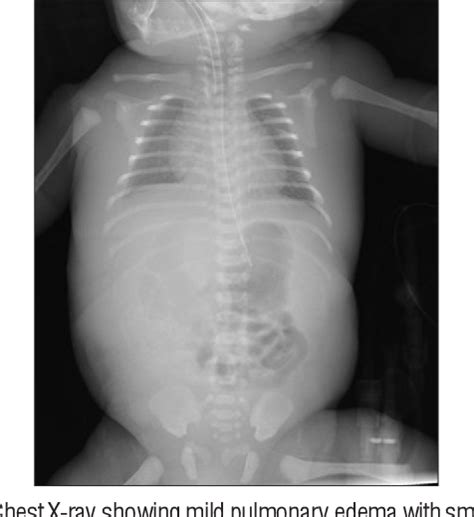 Figure 3 From A Rare Case Of Fetal Meconium Peritonitis Developing