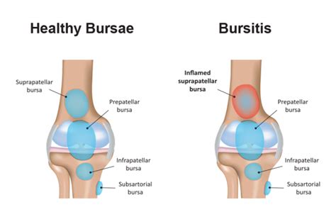 Treatment for bursitis at Bodyline Health - Bodyline Health™ Lower ...