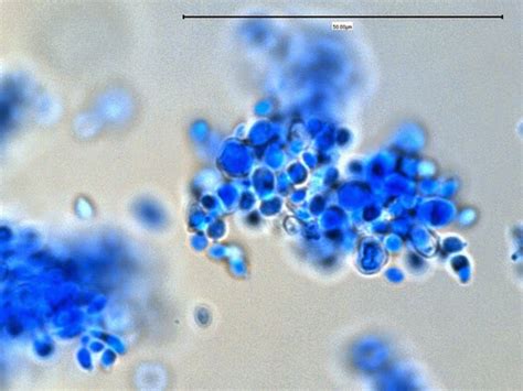 Fun With Microbiology (What's Buggin' You?): Sporothrix schenckii ...