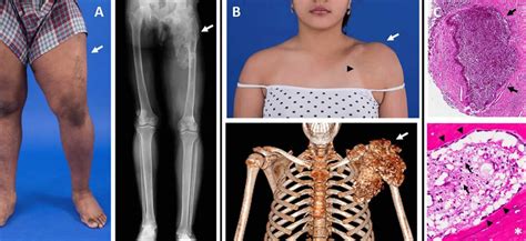 Tumoral Calcinosis Definition Causes Symptoms Diagnosis Treatment