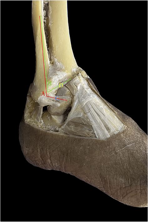 Anatomic Measurement A Angle Between The Anterior Talofibular