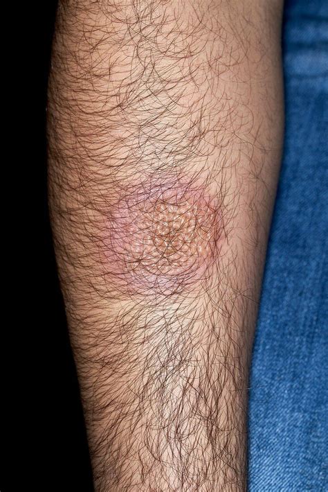 Erythema Multiforme Rash In Herpes  Bild Kaufen 12895624 Science Photo Library