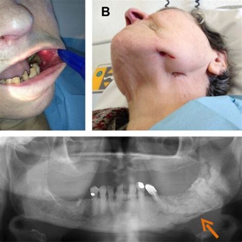 Panoramic Dental X Ray Showing Right Mandibular Osteomyelitis “lumpy Download Scientific