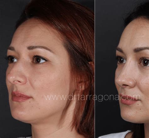 Rinoplastia preservadora Antes y después Dr Tarragona