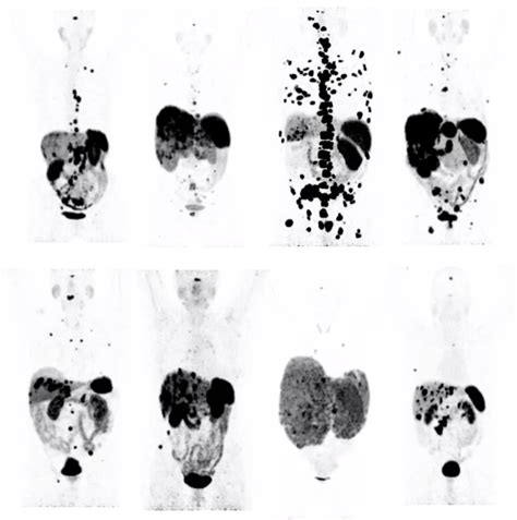 Gastrointestinal Neuroendocrine Tumors And The Carcinoid Syndrome