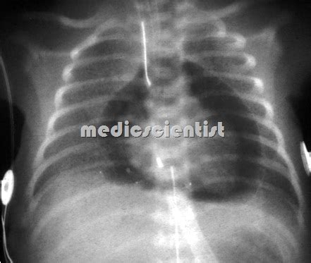 CARDIAC TAMPONADE Causes with Physical findings and Treatment - || MedicScientist :: Total ...