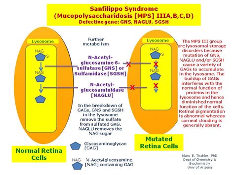 Sanfilippo Syndrome Mps Iiia B C D Hereditary Ocular Diseases