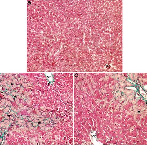 Microscopy Revealed Liver Cirrhosis Masson Trichrome Stain 400 Images