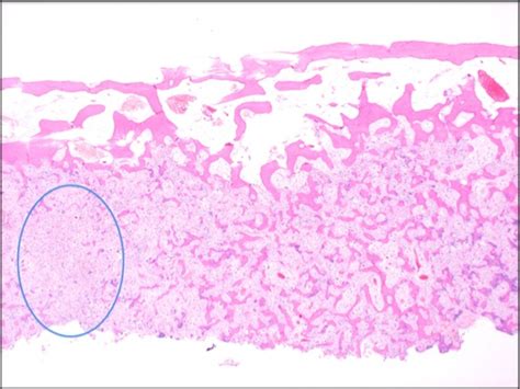 Osteoid Osteoma Histology