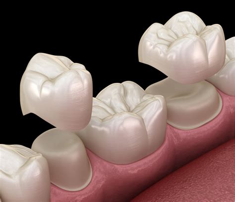 Dental Crowns Maitland Fl Regain Confidence In Your Smile