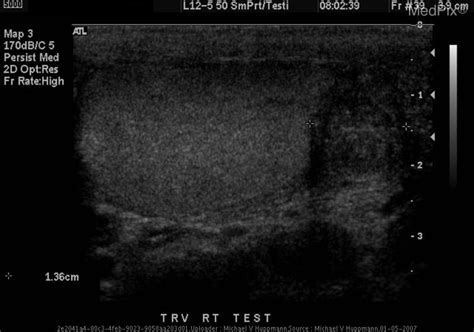 Epididymitis Ultrasound