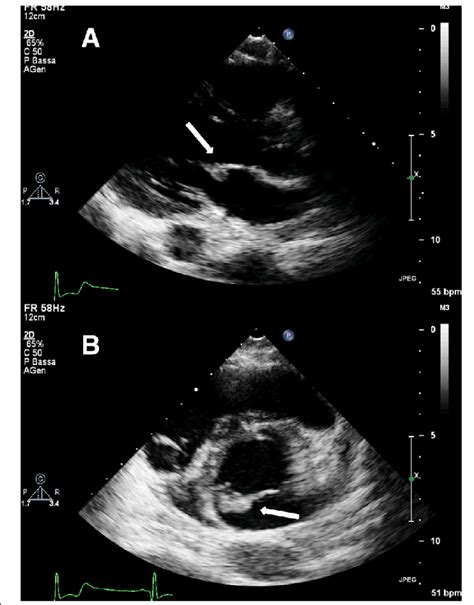 Transthoracic Echocardiogram The Long Axis Panel A And Short Axis