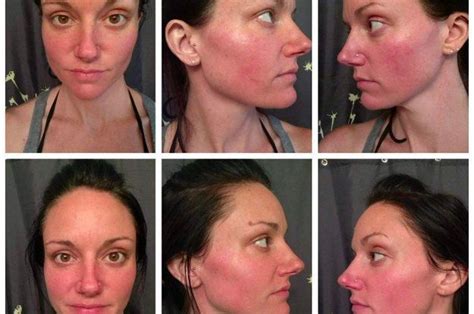 25 Skincare Products Thatll Give You Dramatic Before And After Photos Acnebeforeandafter