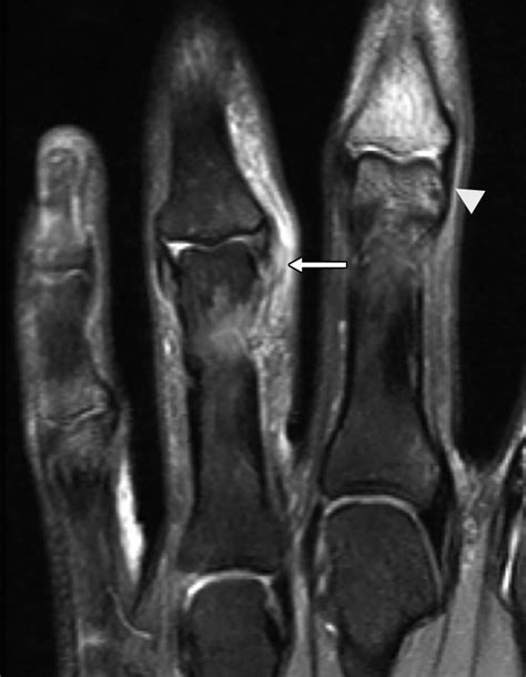 High Resolution 3 T MRI Of The Fingers Review Of Anatomy And Common