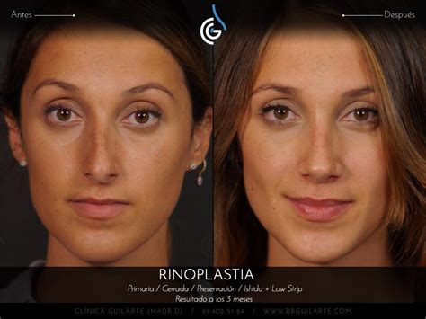 Preservaci N En Madrid Foto Caso Real Rinoplastia Drguilarte