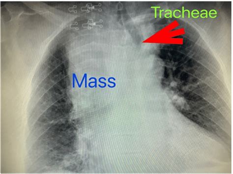 Chest X Ray Demonstrating A Widened Mediastinum With Tracheal Deviation Download Scientific