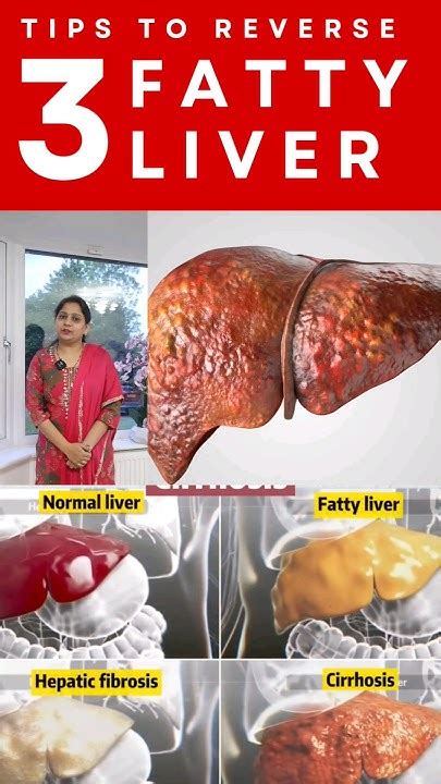 Clean Your Fatty Liver Naturally Dr Spandana Weightloss Fattyliver Shorts Tipsytshorts