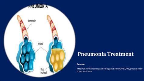 Ppt Pneumonia Treatment Powerpoint Presentation Free Download Id 7495791