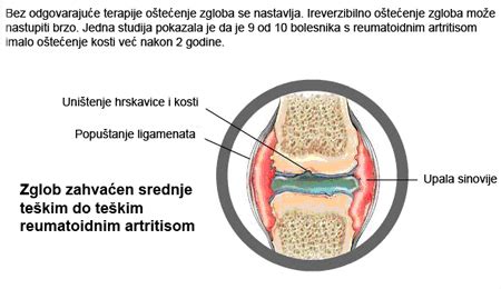 Reumatoidni artritis Kako izgleda klinička slika RA