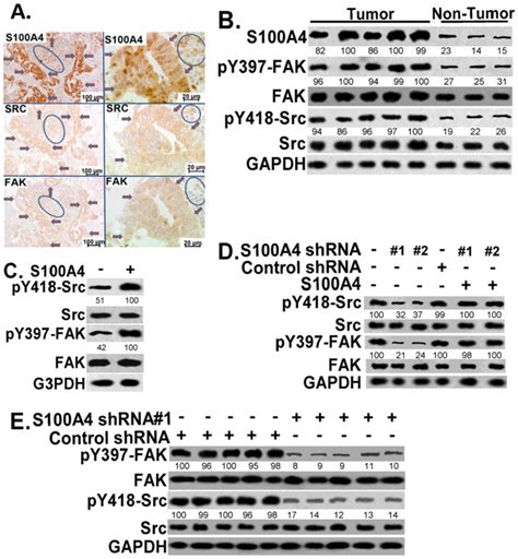 S A Promotes Pancreatic Cancer Progression Through A Dual Signaling