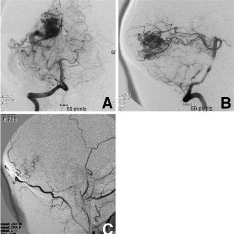 A B Right Vertebral Angiograms Anteroposterior A And Lateral B