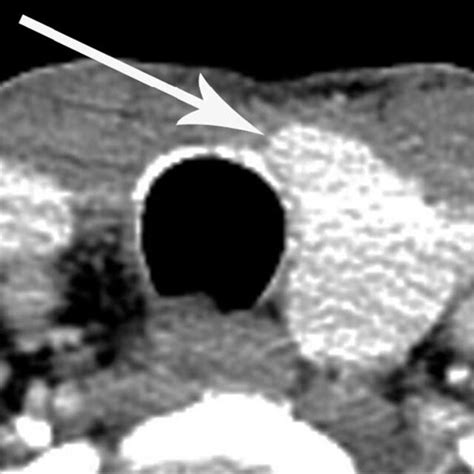 A 61 Year Old Woman With Left Hemithyroidectomy For Papillary Thyroid