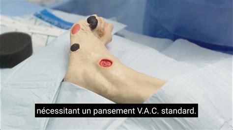 Vac Dressing Foot Wound Bridging Technique Pansement Vac Technique De