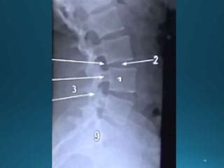 La Columna Vertebral Ppt Descarga Gratuita