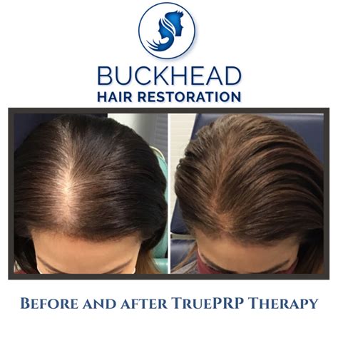 Natural Looking Hair Restoration With Neograft And Prp Therapy