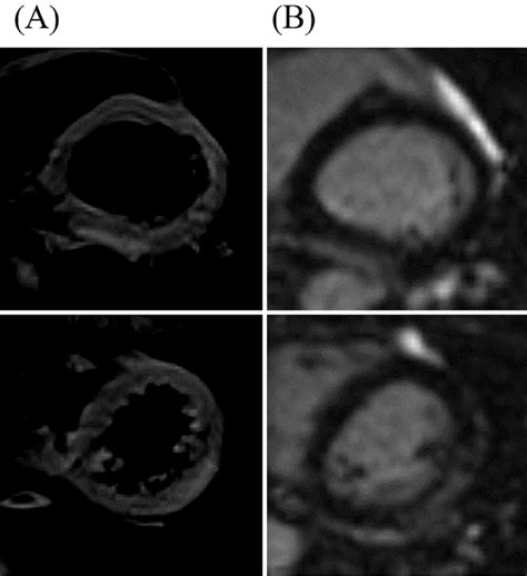 Figure4 Cardiac Magnetic Resonance Imaging Findings On Admission