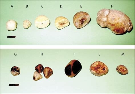 Cholesterol Gallstone Disease The Lancet